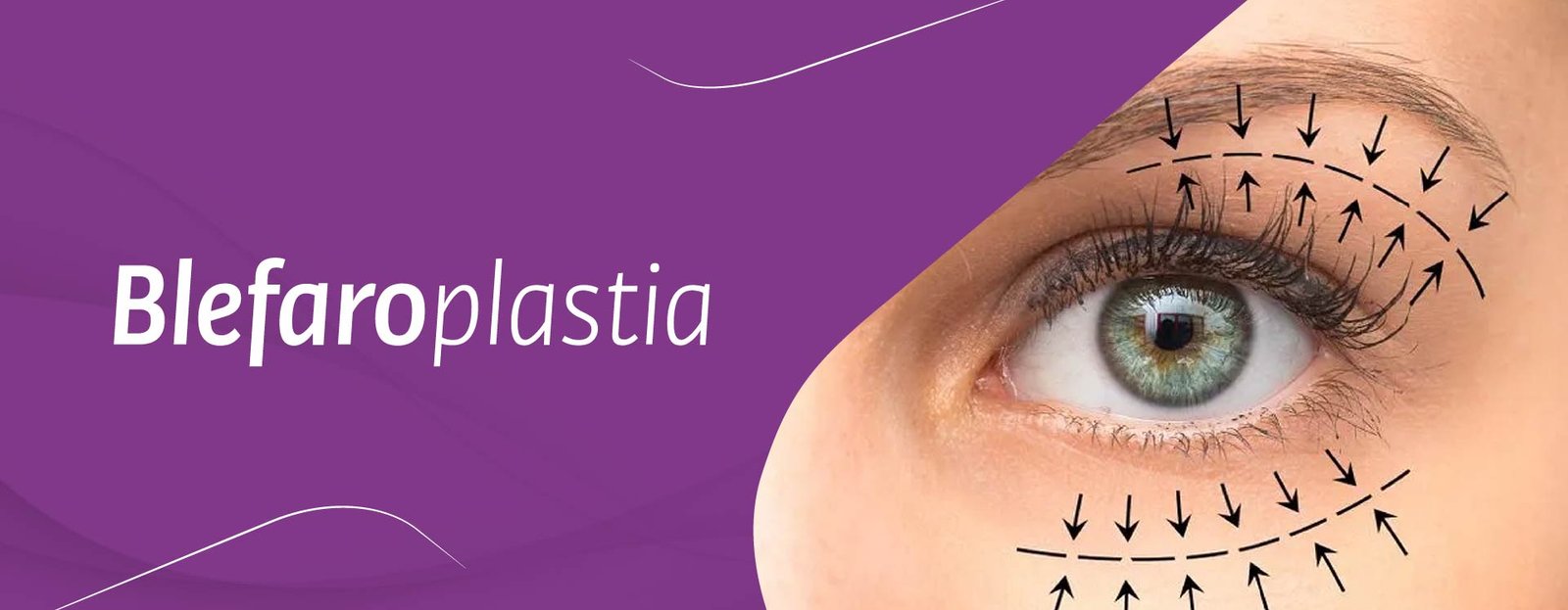 Blefaroplastia